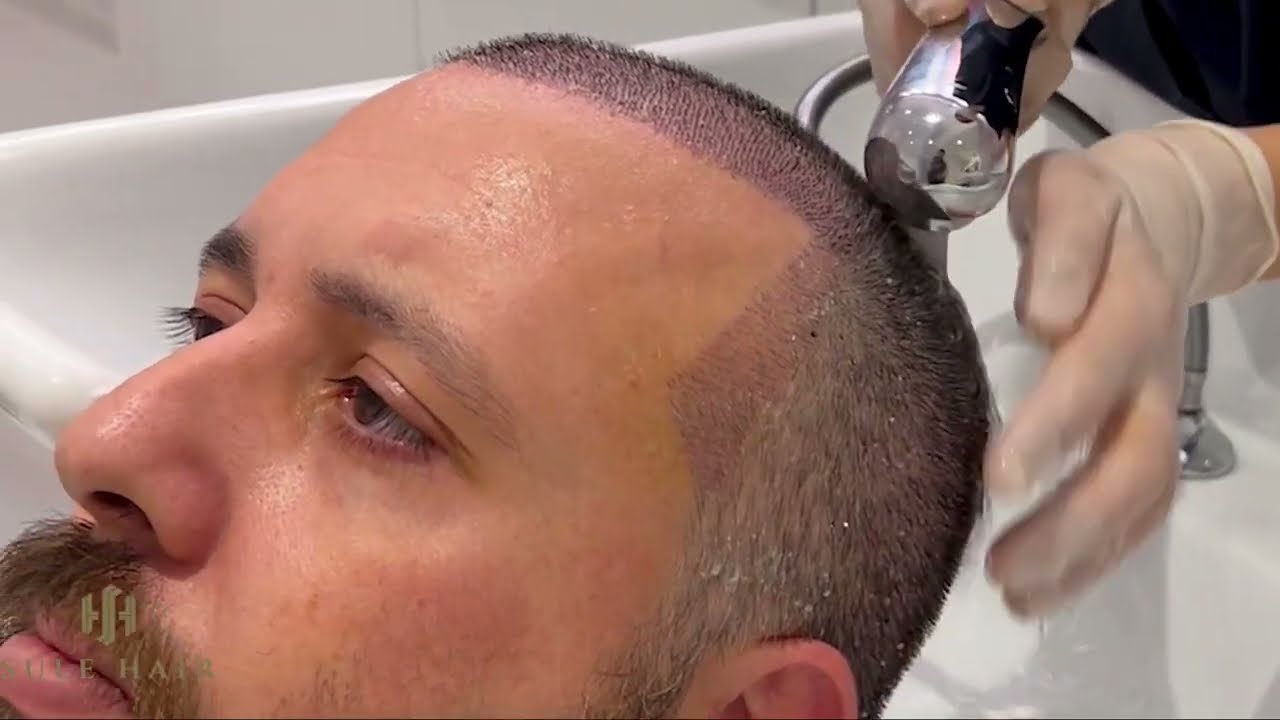 Scabs on Scalp: Everything You Need to Know - Wimpole Clinic