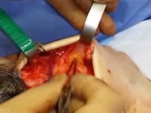 Buccal Fat Excision During a Facelift Operation