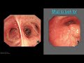 Mastering Bronchoscopy for Thoracic Surgery: Chapter 4