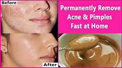 In 3 DAYS- Permanently Remove Acne & Pimples Fast at Home | Overnight Acne & Pimples Treatment