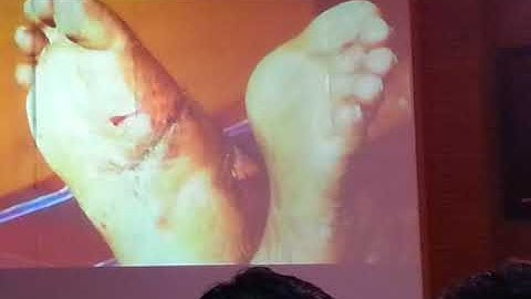 infected non union - orthopaedic case presentation video 6