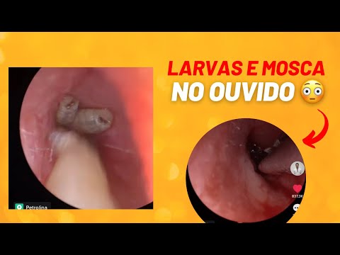 Remoção de larvas e mosca do ouvido 🐛🪰👂🥴😵‍💫😳😱 / myiasis and fly in the ear