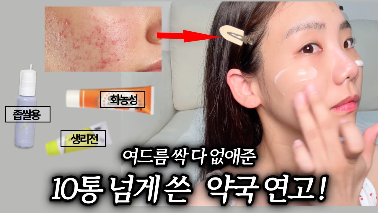 가장 효과 봤던 약국 연고! #여드름연고