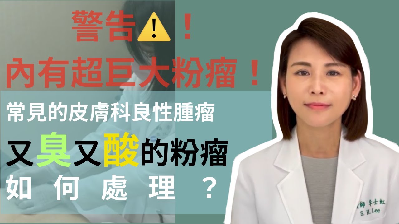 常見的皮膚良性腫瘤～酸又臭的粉瘤，怎麼處理呢？