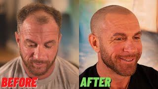 AMAZING RACE Star gets SCALP MICROPIGMENTATION