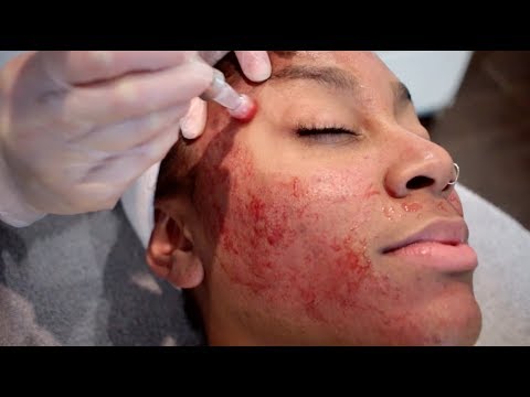 THE TRUTH ABOUT MICRONEEDLING | HOW I GOT RID OF MY ACNE SCARRING!