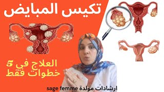 تكيس المبيض الأسباب والأعراض والعلاج