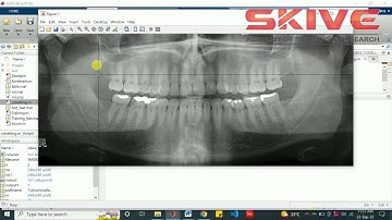 Osteoporosis Detection Model Using Dental Panoramic Radiography | #matlab  #imageprocessing