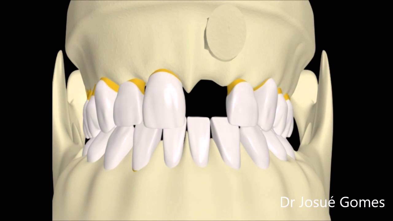 Enxerto ósseo para a instalação de implante dentário YouTube Enxerto ósseo para a instalação de implante dentário YouTube