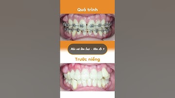 Hành trình LỘT XÁC nhờ niềng răng của Quế Thảo
