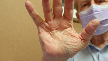 Mayo Clinic Minute - Treating Dupuytren’s contracture without surgery