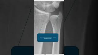 #distal radius and ulnar styloid process fracture Profile