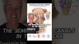 When the Epley maneuver has failed upper cervical Chiropractic can be the answer