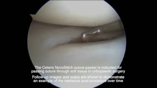 NovoStitch Meniscus Vertical Tear with 1yr PostOp VisionScope