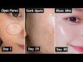 Damaged Skin Repair in 30 Days - Close LARGE OPEN PORES & Remove Dark Spots | Get GLASS Skin