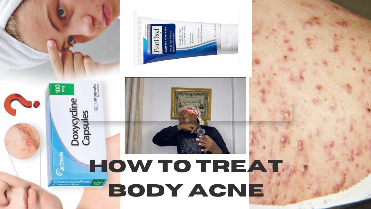 How to Treat Body Acne Chest and back acne Updated methods 2024