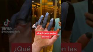 Dedos Congelados medicina doctor casoclnico