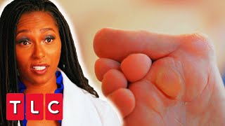 5 HOUR SURGERY Fixes Severely Deformed Feet | My Feet Are Killing Me