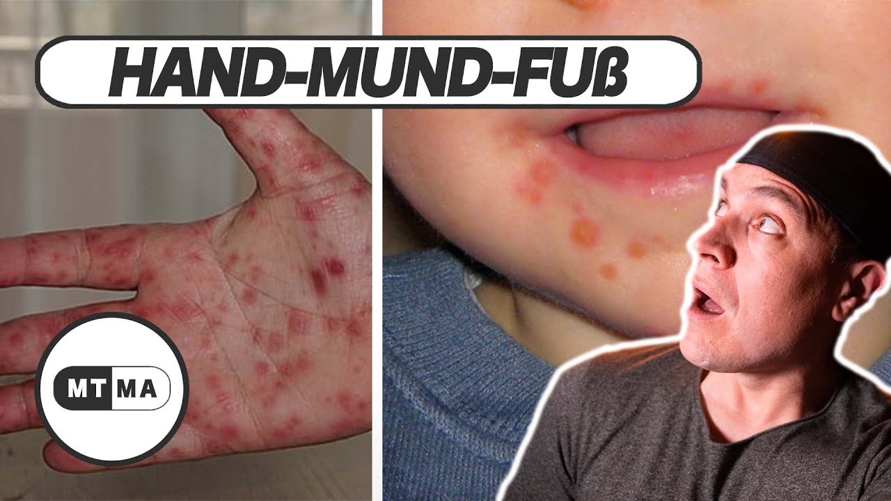 Ist Hand Mund Fuß Für Erwachsene Ansteckend Hand-Fuß-Mund-Krankheit - Gefährlich oder Harmlos? - YouTube