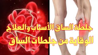 اعراض جلطة الساق وخطورتها والعلاج والوقاية منها_مع الدكتور