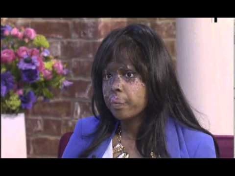 Acid attack victim Naomi breaks down in tears on This Morning
