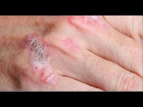 the-miracle-plant-that-treats-eczema,-psoriasis,-dermatitis-and-other-skin-allergies