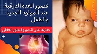 قصور الغدة الدرقية عند المولود الجديد والطفل :الأسباب-الأعراض-العلاج 