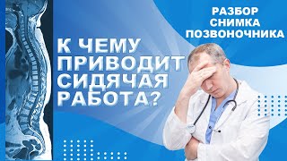 Разбор снимка позвоночника. К чему приводит сидячая работа?