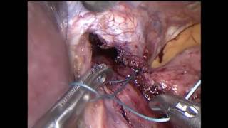 Operación de Heller-Dor video-laparoscopica