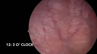 Female cystoscopy step by step HD