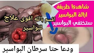 علاج البواسير مسحة واحدة و بدون ادوية  مع اسرار حصرية في الطب البديل/ تعالج حتى سر طان البواسير