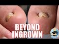 ITALIAN MOBSTER GETS HIS INGROWN TOENAILS RIPPED OUT!!!