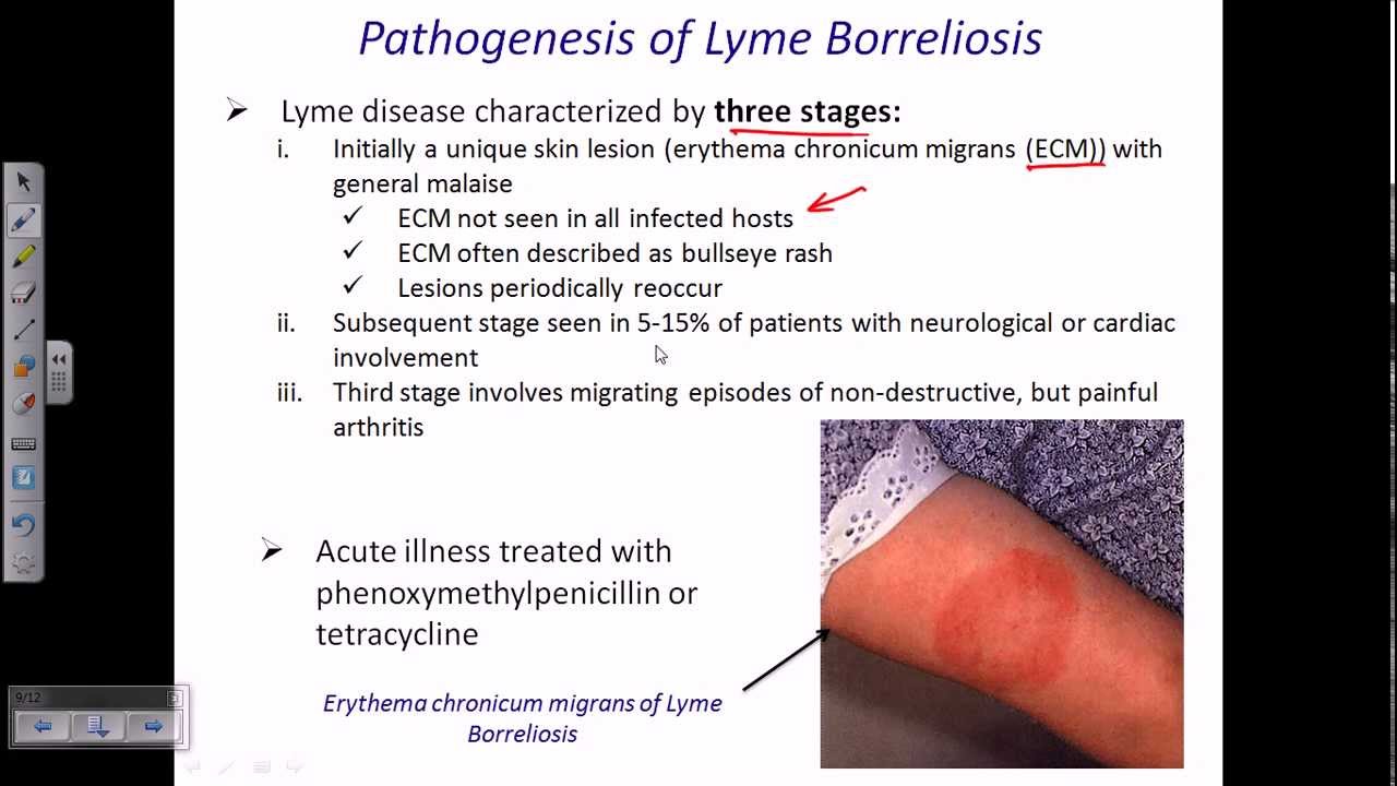 Lyme Disease By Borrelia Youtube