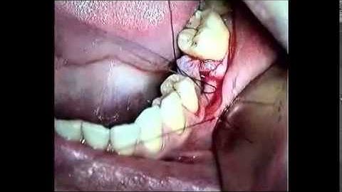 Horizontal Matress - Prof. Mauro Labanca