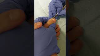 How to file the sides of the nails to combat ingrowth.