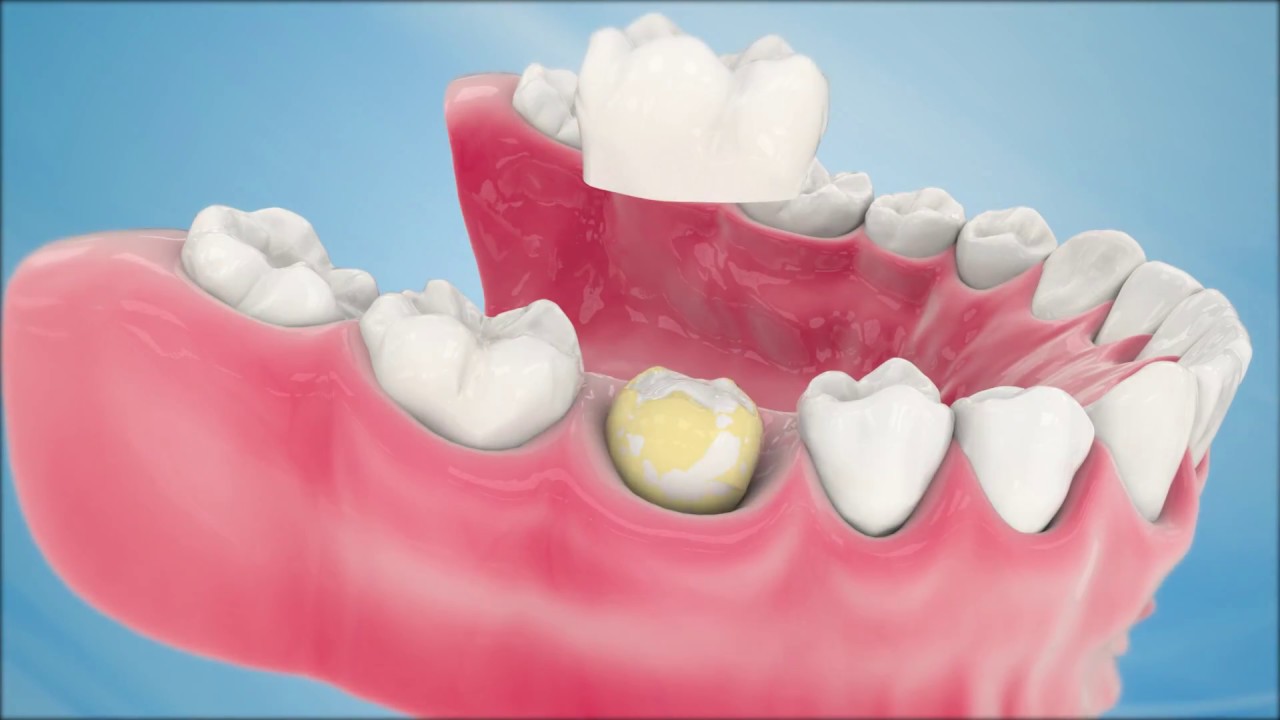 Dental Crown Procedure