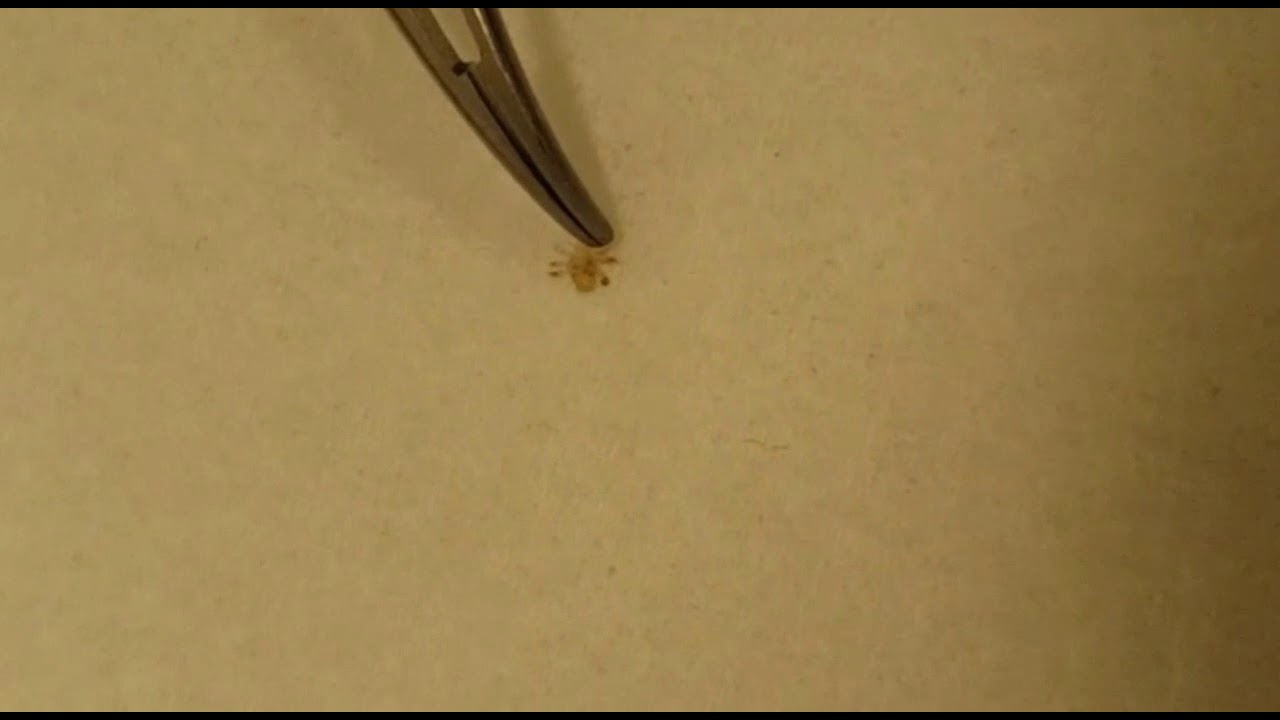 Ocular crab louse pthirius pubis. Phthiriasis palpebrarum YouTube