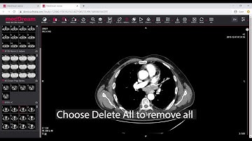 MedDream DICOM Viewer: delete measurements