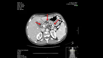 ¿Puede un TAC detectar la pancreatitis?