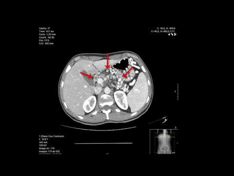 Video: ¿Aparecería el cáncer de ovario en una tomografía computarizada?