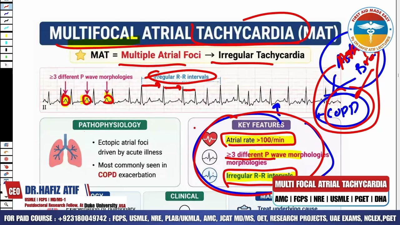 MULTIFOCAL ATRIAL TACHYCARDIA | High-Yield Topic | Dr Hafiz Atif | CVS System | FAME Platform 
