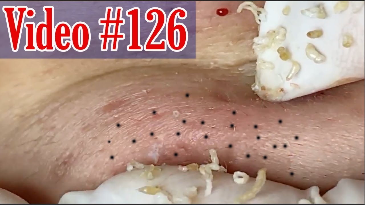 Removal blackheads under skin Young girl 17 year old - Acne Treatment 126
