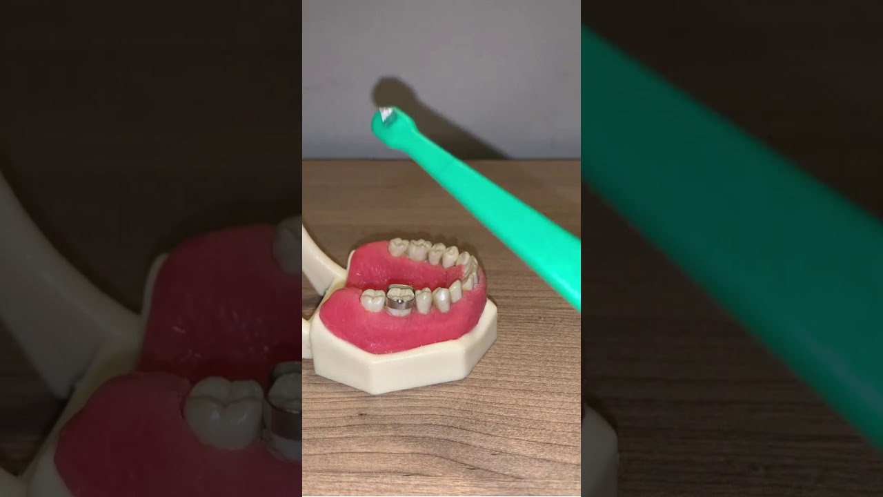 Passo a passo da transferência de banda ortodôntica para confecção de aparelhos dentários fixos.