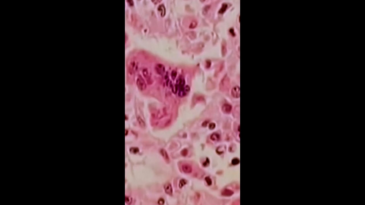 Pennsylvania’s measles outbreak shows no sign of slowing