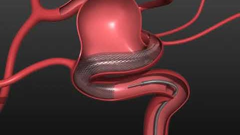 EV3 Pipeline Embolization Device