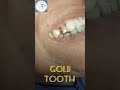 GOLD TOOTH