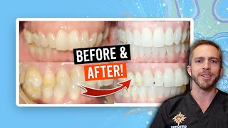 Adult Braces Overbite Treatment: [BEFORE &amp; AFTER]