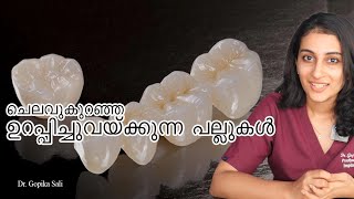 ഉറപ്പിച്ച് വയ്ക്കുന്ന പല്ലുകൾ | Cost of Fixed dental bridges and Crowns | അറിയേണ്ടതെല്ലാം!