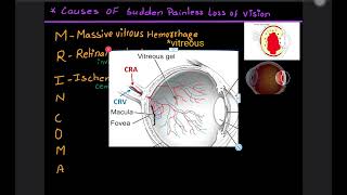 ophthalmology causes of sudden painless loss of vision |  viva questions for mbbs ,MD | USMLE