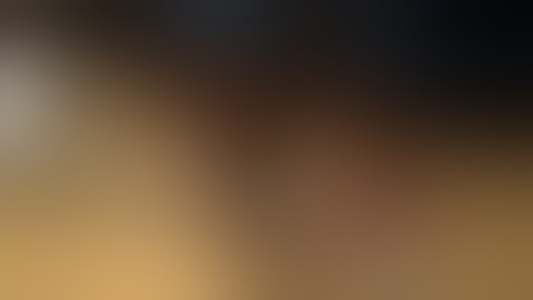 Volar Approach for Scaphoid Fracture   VuMedi 2